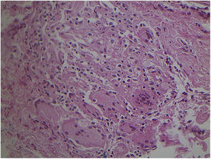 Non-specific granulomatous reaction caused by Mycobacterium fortuitum in an immunocompetent patient (Hematoxylin & eosin, ×40). Diagnosis was performed by amplification and partial genetic sequencing of the rpoB gene. Detection of mycobacteria can be hindered by the extensive granulomatous reaction.