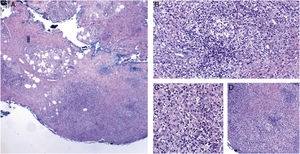 Cutaneous mycobacteriosis caused by Mycobacterium haemophilum in an immunosuppressed patient caused by the use of infliximab for 15 years. Intense infiltration, predominantly constituted of histiocytes, can be seen at the dermo-hypodermic junction, permeated by lymphocytes and neutrophils, but without forming halos, nodules, suppurative foci. Staining: Hematoxylin & eosin; diagnosis carried out by amplification and partial genetic sequencing of the folP1 gene. (A), Panniculitis, ×4; (B), Poorly organized granuloma, ×20; (C), Detail of lymphohistiocytic infiltrate, ×40; (D), Panniculitis with nodular outline, ×10.