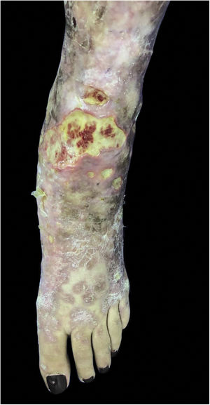 Non-tuberculous cutaneous mycobacteriosis. Polymerase chain reaction was positive for Mycobacterium sp. and negative for Mycobacterium tuberculosis specific primers. The genetic sequencing was inconclusive. The condition showed complete cure after treatment using a regimen for pulmonary tuberculosis associated with clarithromycin.