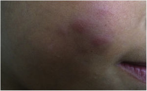 Cutaneous mycobacteriosis by Mycobacterium fortuitum, similar to lupus vulgaris. Diagnosis was performed by amplification and partial genetic sequencing of the rpoB gene.