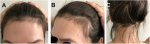 Case 1: (A), Frontal fringe. (B), hair rarefaction on the temporal region and (C), occipital fringe of hair regrowth after effluvium in the post-partum period.