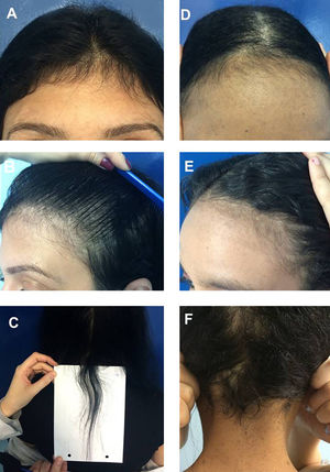 Case 4: (A), Frontal fringe. (B), hair rarefaction on the temporal region and (C), occipital hair regrowth fringe after a serious car accident; Case 5: (D), Frontal fringe, (E), temporal rarefaction and (F), occipital hair regrowth fringe post-effluvium after severe intestinal infection.