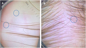 Analysis of hair ends: (A), the tapered ends correspond to short regrowing hairs. (B), Trichoscopy of the occipital area shows several short hairs with tapered ends.