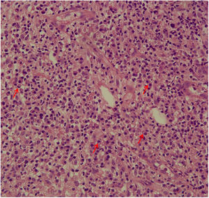Plasma cells (red arrows) in the dermis of a fragment of skin biopsy of a CL ulcer (×400).