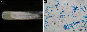 Face ulcer culture. (A), Trichosporon spp. colonies showed a raised, waxy appearance with radial furrows on Sabouraud culture. (B), Culture smear revealed hyphae, blastoconidia and arthroconidia with cotton blue stain.