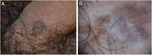 (A), roundish, irregularly pigmented macule of the penile shaft. (B), polarized light dermoscopy showing an irregular brownish pigmentation, multiple brown-grey dots and globules, and structureless whitish areas.