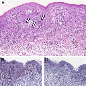(A), Histopathology showing in the epidermis atypical features consisting of abnormal maturation of keratinocytes, prominent nucleoli, and many dyskeratotic cells (arrows). In the superficial dermis, ectatic vessels, a moderate lymphohistiocytic infiltrate and melanophages may be observed (Hematoxyline & eosin, ×150). (B), At immunohistochemistry CD1a + Langerhans cells, may be observed (Immunohistochemical, ×200). (C), Immunohistochemical staining for Melan A showed no atypical melanocytes. Hyperpigmentation of keratinocytes of the basal layer is evident (Immunohistochemical, ×150).
