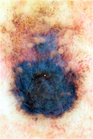 Blackish lesion, measuring 1.2 cm in diameter, with a hypopigmented halo; dermoscopy shows irregular borders and a bluish-gray veil.