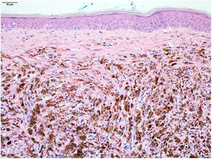 Close-up of the heavy melanophage infiltrate in the dermis (Hematoxylin & eosin, ×100).