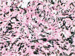 Presence of macrophages full of melanin pigment (melanophages), better seen in H&E after counterstaining with Giemsa.