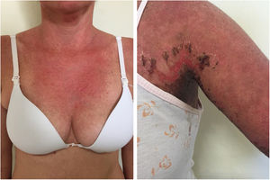 Acute LE and NET-like. Left: acute LE: diffuse erythema on the neck, in a sun-exposed area. Right: erythema and diffuse edema with exulcerations and crust formation, characterizing the more evident detachment of the skin in the axillary region (“lupus with bullae”).