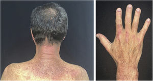 Dermatomyositis. Left: characteristic erythema on the posterior cervical region and upper back (“shawl sign”). Right: erythema on the back of the hands (Gottron’s sign).