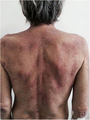 Adult-onset Still’s disease – flagellated lesions. Linear flagellate macules of adult-onset Still’s disease.