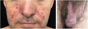 Behcet’s disease. Acneiform vesico-pustules on the face and ulcers on the scrotum (painful).