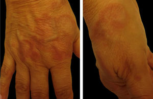 Granuloma annulare. Dr. Alexandre Gripp’s personal collection.