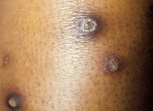 Acquired perforating dermatosis (Kyrle’s disease). Dr. Alexandre Gripp’s personal collection.