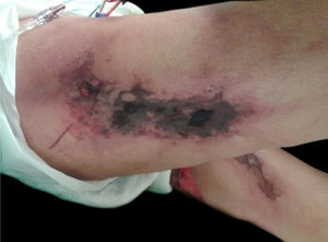Calciphylaxis. Dr. Ana Luisa Sampaio’s personal collection.