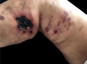 Intravascular oxalosis. Dr. Ana Luisa Sampaio’s personal collection.