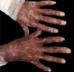 Porphyria cutanea tarda. Dr. Ana Luisa Sampaio’s personal collection.