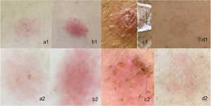 Patch tests: (a1), Weak reaction (1+) with the naked eye; (a2), Weak (1+) with dermoscopy; (b1), Strong (2+) with the naked eye; (b2), Strong (2+) with dermoscopy; (c1), Very strong (3+) with the naked eye; (c2), Very strong (3+) with dermoscopy; (d1), Doubtful reaction observed with the naked eye; (d2), 1+ reaction with dermoscopy.