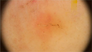 Dermoscopic image of scabies showing a brownish triangular structure followed by a whitish linear structure forming the “jet with contrail” image. (FotoFinder, original magnitude ×20) Source: Authors