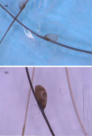 Dermoscopic image of pediculosis, showing empty (A) and viable (B) nits. (FotoFinder, original magnitude ×20) Source: Hospital de Clinicas de Porto Alegre collection.