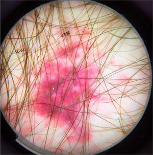 Dermoscopic image of disseminated strongyloidiasis showing homogeneous purpuric areas. (FotoFinder, original magnitude ×20) Source: Hospital de Clinicas de Porto Alegre collection.