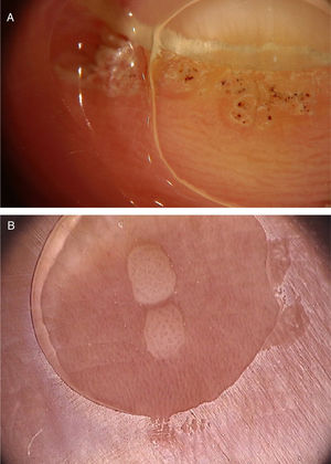 (A), Dermoscopic image of a verruca vulgaris in the subungual region showing hyperkeratosis and dotted or thrombosed vessels; (B), Dermoscopic image of a verruca plana showing discrete homogeneously distributed dotted vessels. (FotoFinder, original magnitude ×20). Source: Authors' personal collection.