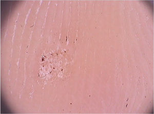 Dermoscopic image of a verruca plantaris with hyperkeratosis and thrombosed vessels. (FotoFinder, original magnitude ×20). Source: Authors
