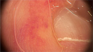 Dermoscopic image with erythematous-violaceous areas in a patient with perniosis-like erythema detected during the COVID-19 pandemic. (FotoFinder, original magnitude ×20). Source: Authors