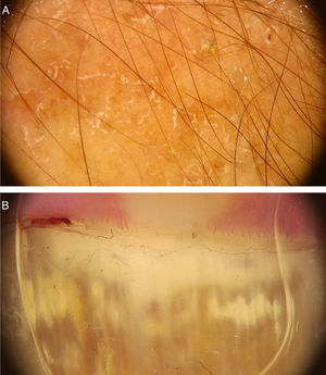 Dermoscopic image of tinea corporis showing areas of erythema and scaling (A) and of onychomycosis showing white-yellowish streaks in the proximal portion of the nail plate (B). (FotoFinder, original magnitude ×20). Source: Authors