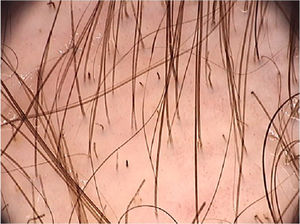 Dermoscopic image of tinea capitis showing broken and “comma-shaped” hairs (FotoFinder, original magnitude ×20). Source: Authors