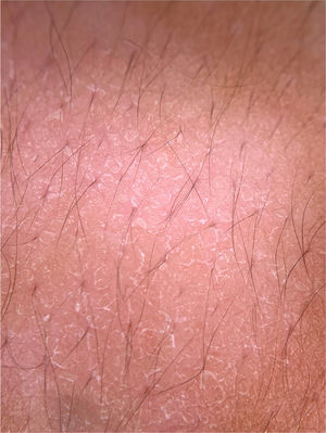 Dermoscopic image of pityriasis versicolor, demonstrating diffuse fine scaling. (FotoFinder, original magnitude ×20). Source: Authors