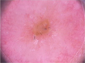 Dermoscopic image of sporotrichosis showing erythema and central areas of erosion. (FotoFinder, original magnitude ×20) Source: Collection of Hospital de Clinicas de Porto Alegre.