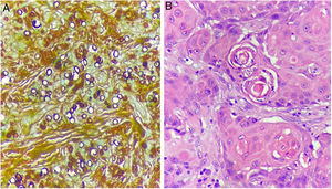 (A), Numerous fungal spores (Grocott, ×400). (B), Proliferation of tumor cells with the presence of atypical mitosis and horn pearls (Hematoxylin & eosin).
