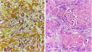 (A), Numerous fungal spores (Grocott, ×400). (B), Proliferation of tumor cells with the presence of atypical mitosis and horn pearls (Hematoxylin & eosin).