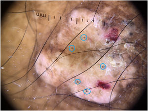 Dermoscopic image of a keloid-like nodular lesion on the lower limb (×10, non-polarized dermoscopy) Several black dots (blue circles).