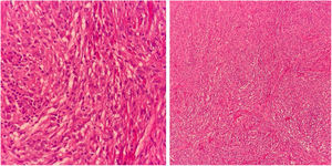 Fusiform histiocytes, arranged in short bundles, occupying the dermis (Hematoxylin & eosin, ×100 and ×400).