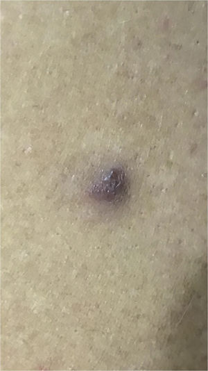 Angiomatous nodule on the lateral aspect of the left arm.