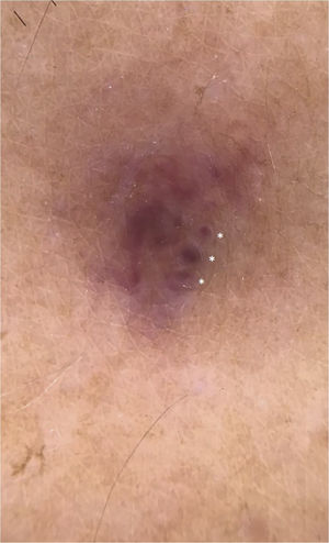 Dermoscopy showed a homogeneous purplish area without structures surrounded by a whitish region, in addition to intensely purplish lagoons, standing out individually and surrounded by a pale halo (asterisks).
