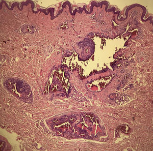 Histopathology showed intradermal nests of monomorphic glomus cells, with rounded nuclei, organized in single or multiple cords around exuberant vascular structures, corresponding to a glomangioma. (Hematoxylin & eosin, ×40).