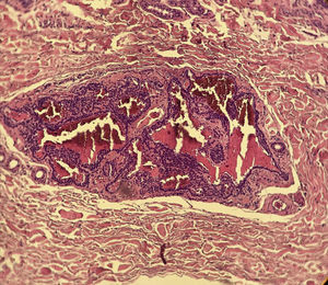 At the center of the histological section, there is a nest consisting of glomus cells, with regular and monomorphic nuclei, surrounding vascular spaces. The adjacent dermis shows thickened collagen fibers. (Hematoxylin & eosin, ×400).