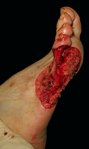 Surgical defect lateral and plantar surface of the right foot measuring 8,5 × 10 cm and involving the fourth interdigital space.