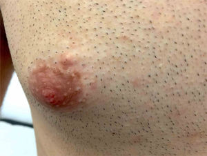 Velvety, soft, and pink papule located on the right periareolar region, corresponding to a superficial cutaneous myxoma.