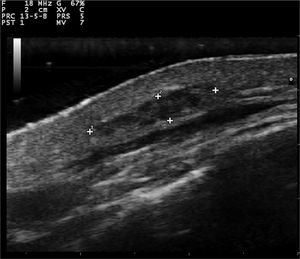 Transverse sonogram (18 MHz) of the subcutaneous myxoma, showing an ill-defined, elongated, heterogeneous, and hypoechoic mass located in the deep dermis and hypodermis.