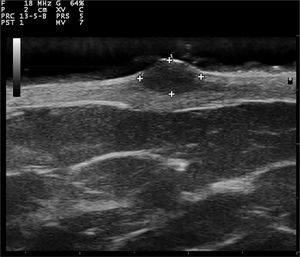 Transverse sonogram (18 MHz) of a superficial myxoma, showing a well-defined, round, homogeneous, and hypoechoic lesion located in the superficial dermis with elevation of the epidermis.