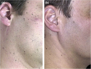 Clinical follow-up images. (A), Multiple small black macules on the face and neck. (B), 7 years later most of the Spitz nevi have completely regressed.