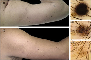 Clinical and dermoscopic follow-up images. (A), Multiple small black and brown macules on the right arm. (B), 7 years later most of the Spitz nevi have completely regressed. (C–E) Dermoscopic follow-up of a representative nevus. C, Starburst pattern: central area of homogeneous black pigmentation and symmetrically distributed peripheral streaks. D, Brown homogeneous pattern. E, Regressing nevus.