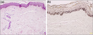 Histopathology of ABTM: (a), Basal hyperpigmentation, capillary proliferation, and dilated capillaries with mild infiltration of perivascular lymphohistiocytes in the upper dermis (Hematoxylin & eosin, ×100). (b), Hyperpigmentation in the basal layer of epidermis (Fontana-Masson, ×200).