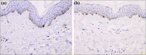 Immunohistochemistry of mastocytes and melanocytes in ABTM: (a), A few CD117 positive mast cells (arrows) around the dilated capillaries in the papillary dermis (×200). (b), Normal Melan-A positive melanocytes in the epidermis (×200).